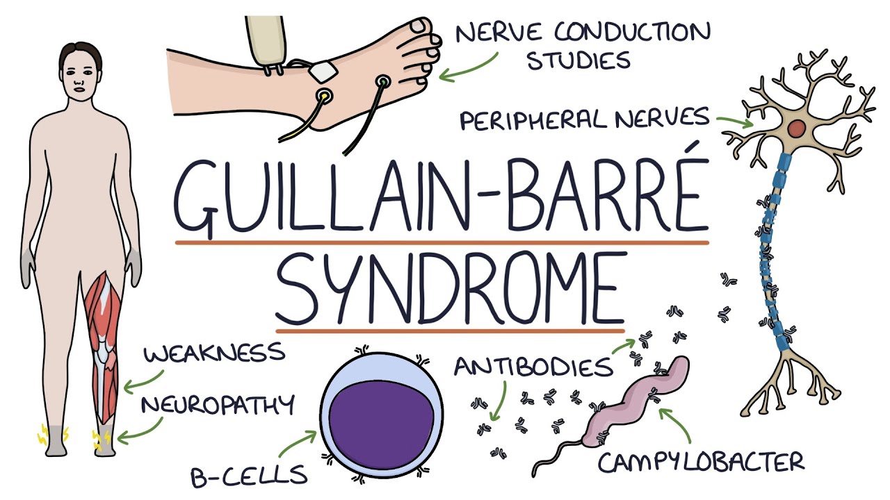 Guillain-Barré Syndrome